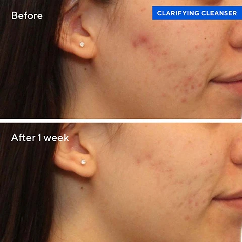 Image 1, before and after 1 week. image 2, 97% said it dissolves excess oil in a 3 day clinical study. image 3, salicylic acid reduces the severity of blemishes, helps keep skin clear by preventing formation of new blemishes and allows skin to heal. green tea extract helps soothe irritation for clearer, healthier looking skin. image 4, your breakout busting regimen. fast acting treatments that work. 1 = cleanse with clarifying cleanser, rinse and pat dry. 2 = dispense clarifying toner onto a cotton pad and sweep over face and neck. 3 - spot treat breakouts with rapid relief blemish spot treatment. 4 = oil and pore control mattifier SPF 45, during the day apply oil and pore control mattifier to face and neck