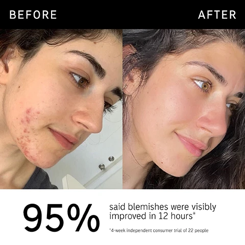 Image 1 - Before and after comparison of a persons face showing significant improvement in skin texture; visible text reads 95% said blemishes were visibly improved in 12 hours and *4-week independent consumer trial of 22 people.
Image 2 - A tube of succinic acid treatment is shown with a green cream swatch beside it, accompanied by visible text stating clinically proven to visibly improve blemishes, clinically proven to visibly reduce redness, and targeted treatment plus non-drying, gentle formula.
Image 3 - A close-up of a woman with a glowing complexion applying a clear gel to her cheek, accompanied by text that states 95% said blemishes were visibly improved in 12 hours, 91% said redness appeared reduced in 4 hours, and 100% said it felt gentle on the skin, with a note about a 4-week independent consumer trial of 22 people.
Image 4 - Image showing a green background with text listing ingredients: 2% Succinic Acid - Helps to reduce appearance of blemishes and excess oil, 2% Sulfur Powder - Absorbs excess oil, 1% Salicylic Acid - Helps unclog pores and gently exfoliate.
Image 5 - A close-up of a woman smiling and applying skincare product on her face, with text overlaying the image that reads: FAQ SHOULD I USE THIS BEFORE OR AFTER OTHER SKINCARE? Apply directly to areas of concern up to 3x a day. Allow 5 minutes to dry before following with the rest of your skincare/makeup. WHAT CAN I LAYER IT WITH? We recommend not applying actives such as AHAs, BHAs, Retinol, Vitamin C or Niacinamide on the same area you wish to use Succinic Acid on.
Image 6 - An illustration of a light green cream swatch is shown above the text that reads How to layer your routine, with numbered steps below: 1. Clean, 2. Hydrate, 3. Treat, 4. Moisturize, 5. SPF.
Image 7 - A close-up of a person pointing to their cheek with a small green product dot on their skin, accompanied by the text: When to apply; AM; PM.
Image 8 - A hand holds a finger out with a small amount of light green cream being dispensed from a tube labeled SUCCINIC ACID TREATMENT and the text on the left reads Amount to apply with Raspberry-sized amount below it alongside a droplet icon.
Image 9 - Image shows a comparison of two skincare products: a tube labeled Succinic Acid Treatment on the left and a box of Hydrocolloid Invisible Pimple Patches on the right, with text sections beneath each product detailing their best uses, hero ingredients, and targets for effectiveness.