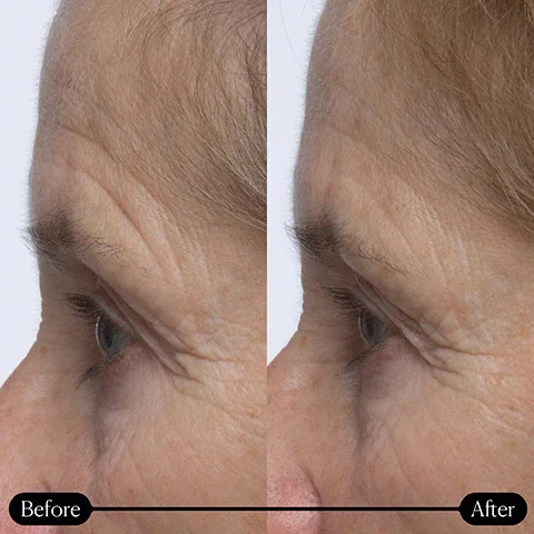 before and after