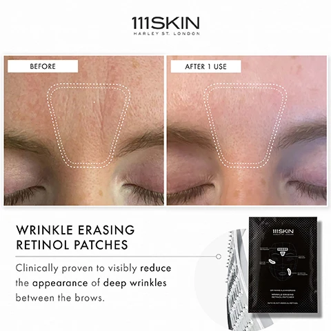 Image 1 - Image shows a before and after comparison of a forehead area with visible wrinkles, with labeled sections BEFORE and AFTER 1 USE, and includes product description WRINKLE ERASING RETINOL PATCHES Clinically proven to visibly reduce the appearance of deep wrinkles between the brows.
Image 2 - Image shows two side-by-side close-up photos of an eye area with wrinkles, labeled Before on the left and After 1 Use on the right, with dotted lines indicating the treatment area; text at the bottom reads WRINKLE ERASING RETINOL PATCHES Clinically proven to visibly reduce the appearance of deep wrinkles between the brows.
Image 3 - Before and after images of a persons eye area showing reduced wrinkles, with visible text stating WRINKLE ERASING RETINOL PATCHES and Clinically proven to visibly reduce the appearance of deep wrinkles between the brows.