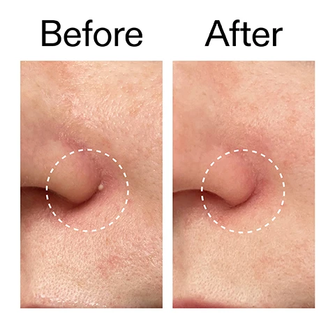 Image 1 - A before and after comparison shows a close-up of a nostril area, with the Before image on the left displaying a prominent whitehead highlighted by a dashed circle, and the After image on the right showing the whitehead significantly reduced or gone; the images are labeled Before and After. Image 2 - A persons hand touches a blemish on their forehead, above the text: Clinically proven to reduce breakouts in 4 hours* *Independent clinical study of 20 people. Image 3 - Close-up of a persons face showing their eyes, nose, and part of their ear with smooth skin, next to the text Why we love it, Helps reduce whiteheads fast, Invisible on skin or under makeup, Stays all day. No slipping or lifting. Image 4 - The image displays text explaining product ingredients and their functions, with two translucent circular patches on the right, listing Why it works, 99% Hydrocolloid, CREATES A PROTECTIVE SEAL TO DRAW OUT GUNK AND FLATTEN BLEMISHES, 0.4% Salicylic Acid, EXFOLIATES AND UNCLOGS, 0.4% Succinic Acid, REDUCES REDNESS AND EXCESS OIL, 0.2% Ectoin, KEEPS SKIN HYDRATED. Image 5 - A close-up of a white surface shows instructions on the left and a sheet of circular clear patches partially visible on the right, reading How to use USE AM + PM AS NEEDED. APPLY TO CLEANSED, DRY SKIN DIRECTLY ON BLEMISH. LEAVE FOR AT LEAST 4 HOURS. REMOVE AND REPLACE AS NEEDED. Image 6 - The image features a white background with translucent white circles and thin vertical lines, displaying text How to layer your routine and a numbered list: 1 CLEANSE, 2 HYDRATE, 3 TREAT, 4 MOISTURISE, 5 SPF.